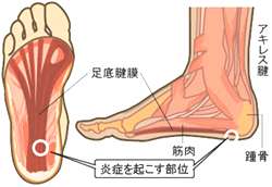 足底腱膜炎