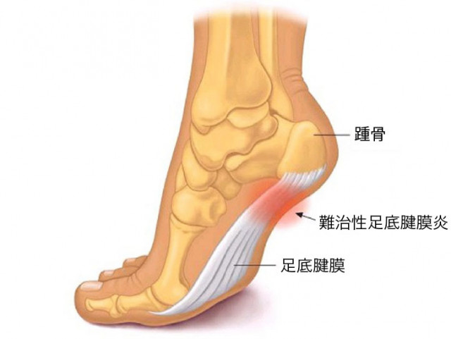 足底腱膜炎