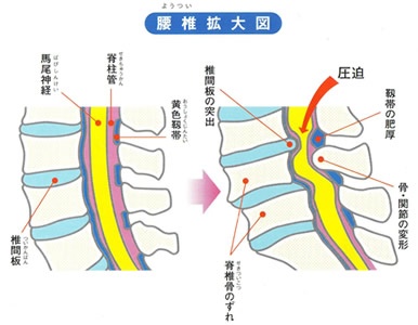 狭山　脊柱管狭窄症の図