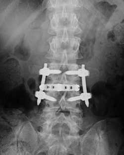 脊柱管狭窄症の一般的な治療法